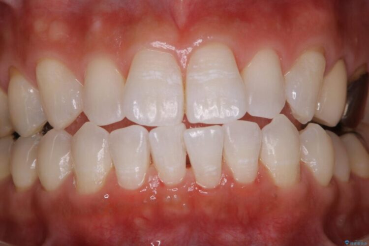 【30代男性】1年ぶりのクリーニング(コーヒーによる着色落とし) 治療後画像