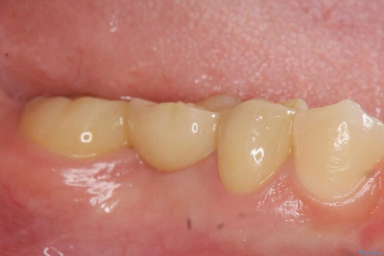 【20代女性】傾斜してしまった奥歯の部分矯正を併用したブリッジ治療 治療後画像