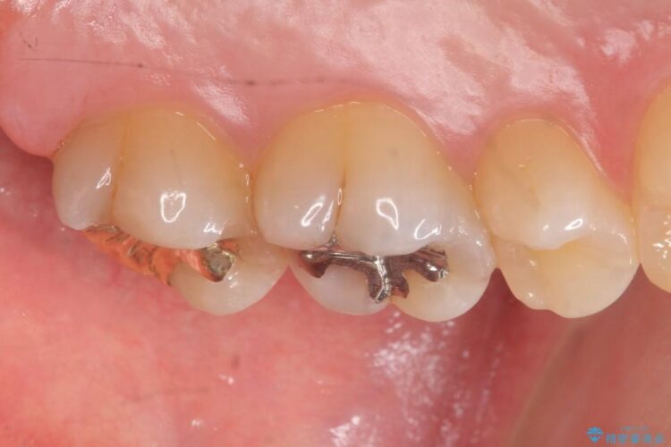 【20代男性】深い虫歯を長持ちするゴールドインレーで治療 治療後画像