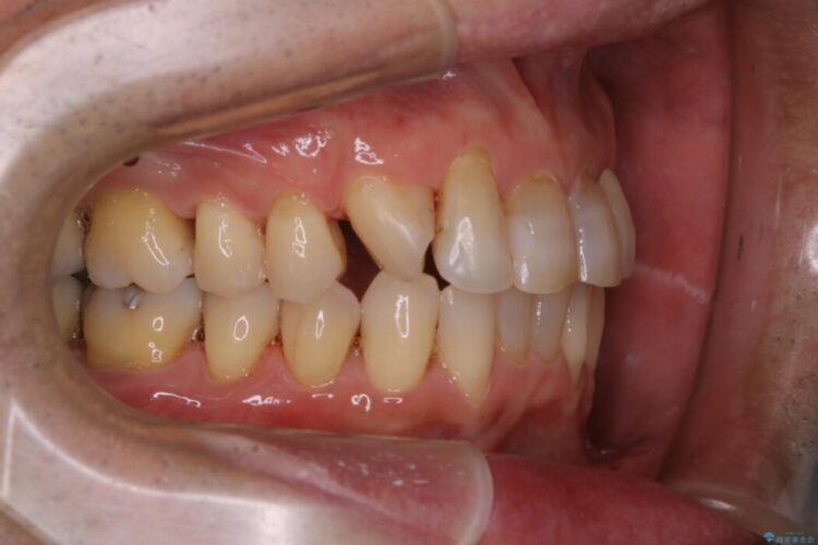 【40代男性】インビザライン治療中の頑固な着色落としをクリーニング 治療後画像