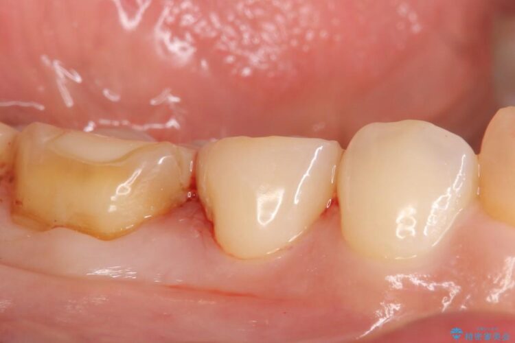 【40代女性】古い不適合な詰め物をセラミックインレーで再治療 治療後画像