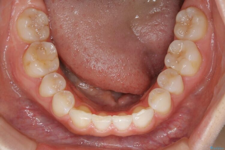 【20代女性】生まれつき歯の本数が足りない先天欠如を治療する 治療後画像