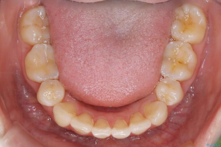 【20代女性】10代の頃にした矯正の後戻りを再矯正する 治療後画像