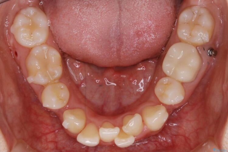 【20代女性】抜歯矯正で叢生をなおす 治療途中画像