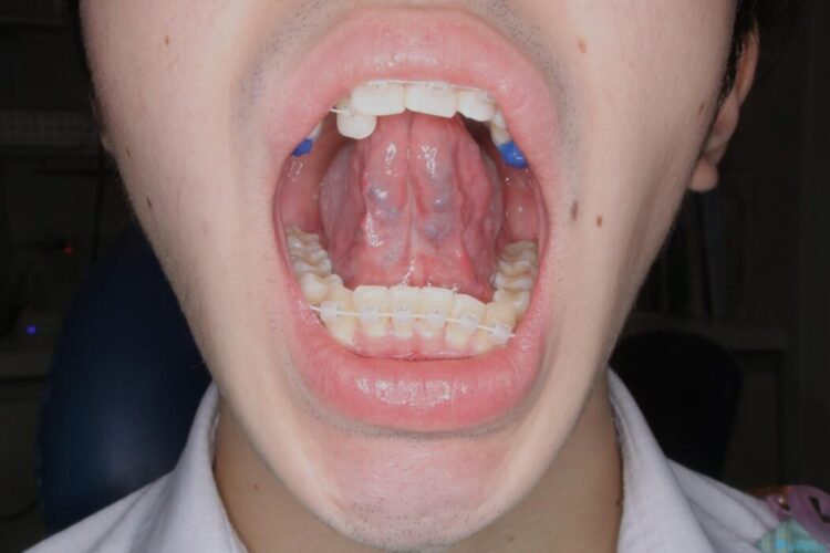 【20代男性】矯正治療前に舌小帯切除で滑舌の改善 治療後画像