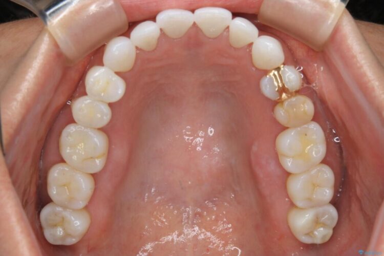 【40代女性】開咬(オープンバイト)の非抜歯インビザライン矯正治療 治療後画像