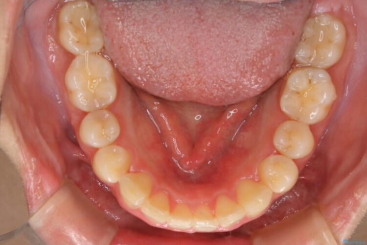 【20代女性】非抜歯で口ゴボ改善するインビザライン矯正治療 治療後画像