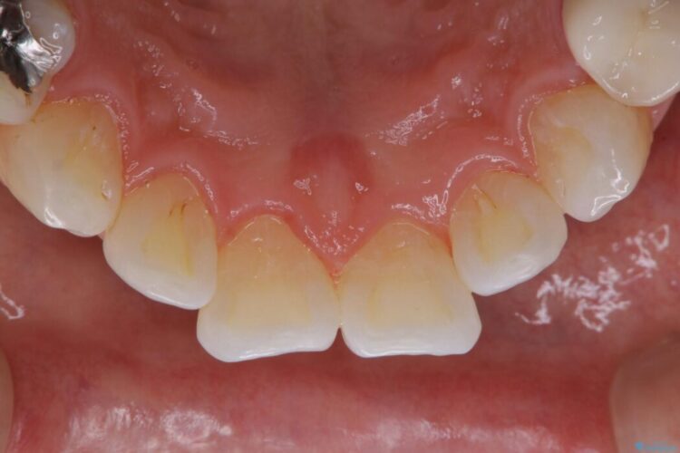 【30代男性】1年ぶりのクリーニング(コーヒーによる着色落とし) 治療後画像