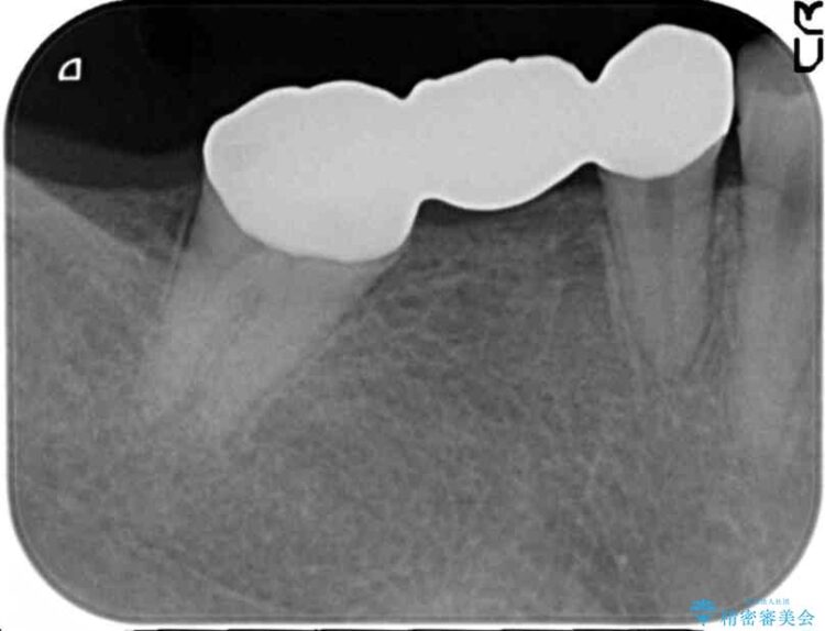 【20代女性】傾斜してしまった奥歯の部分矯正を併用したブリッジ治療 治療後画像