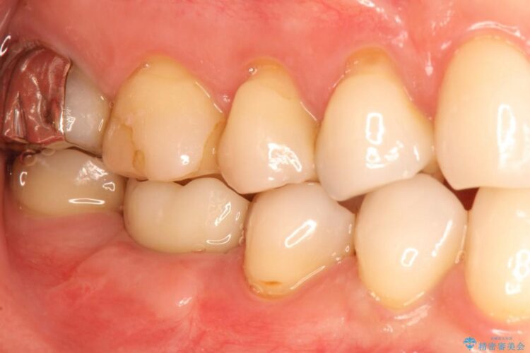 【30代女性】右下奥歯のインプラント 治療例 治療後画像