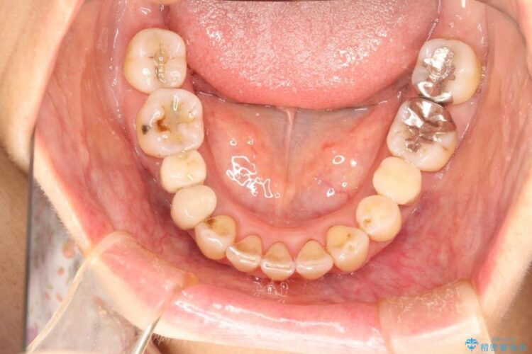 【50代女性】八重歯のインビザライン矯正 治療例 治療後画像