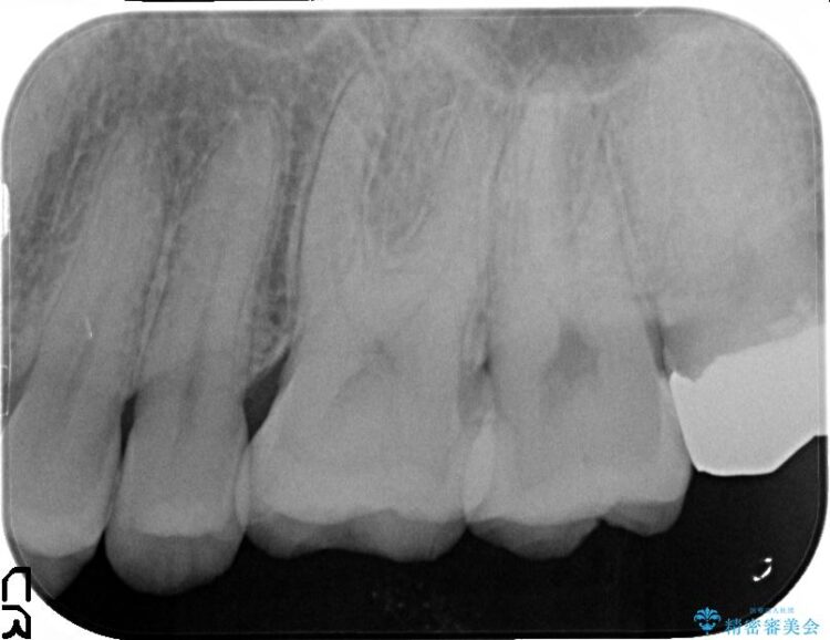 【20代男性】銀歯を白くしたい 治療後画像