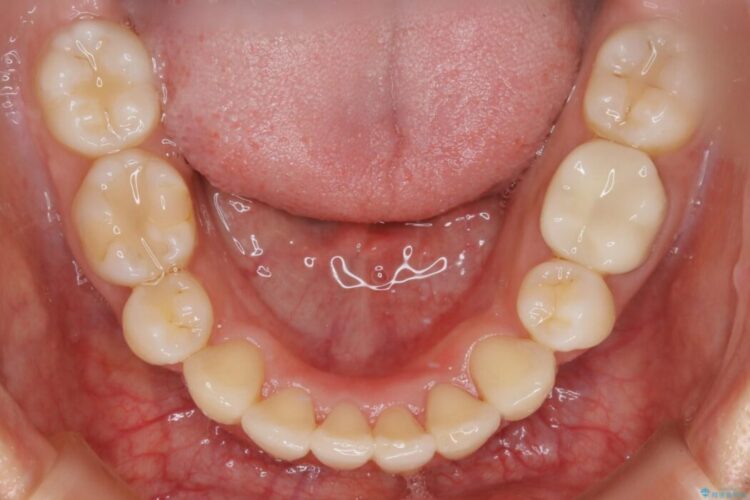 【20代女性】抜歯矯正で叢生をなおす 治療後画像