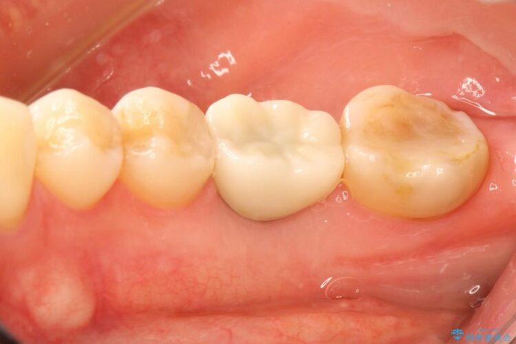 【30代女性】右下奥歯のインプラント 治療例 治療後画像