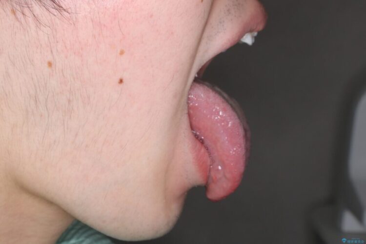 【20代男性】矯正治療前に舌小帯切除で滑舌の改善 治療後画像