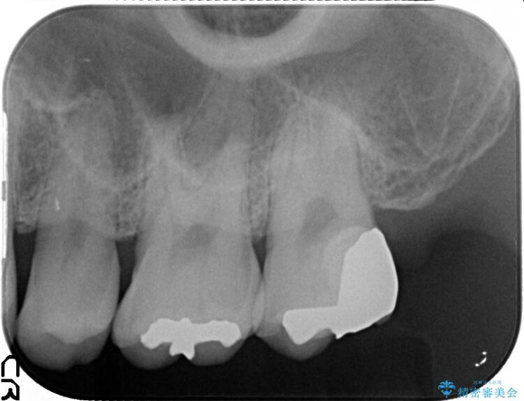 【20代男性】深い虫歯を長持ちするゴールドインレーで治療 治療後画像