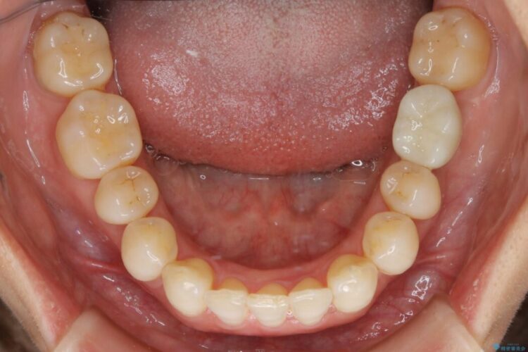 【30代女性】歯根破折と歯列矯正の治療で噛み合わせを改善 治療後画像