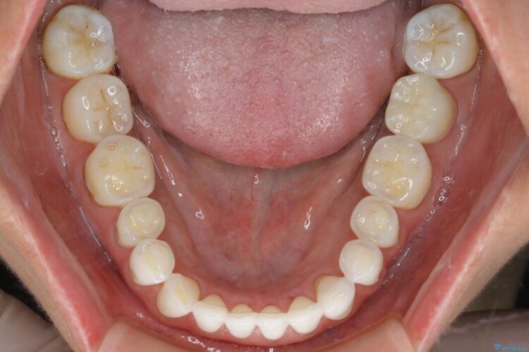 【40代女性】開咬(オープンバイト)の非抜歯インビザライン矯正治療 治療後画像