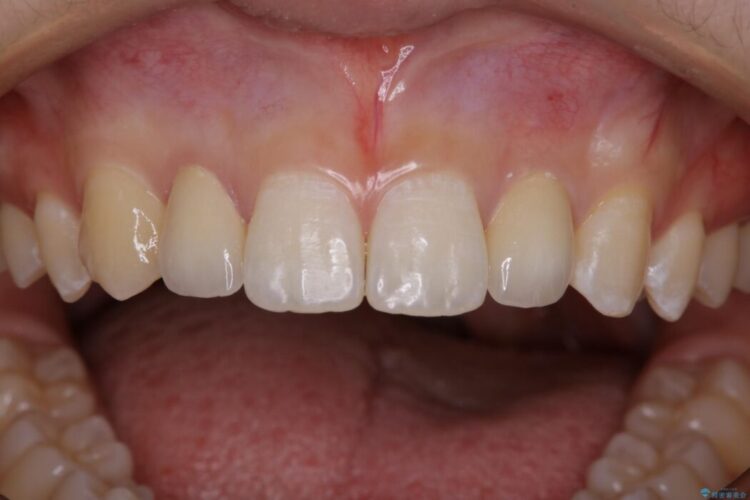 【10代女性】生まれつき小さい歯をセラミックで補綴しすきっ歯を改善する 治療後画像