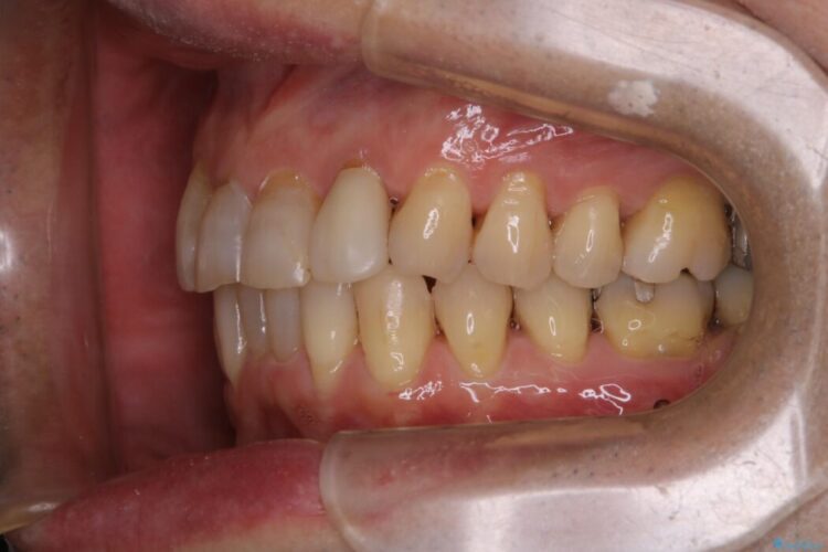 【40代男性】インビザライン治療中の頑固な着色落としをクリーニング 治療後画像