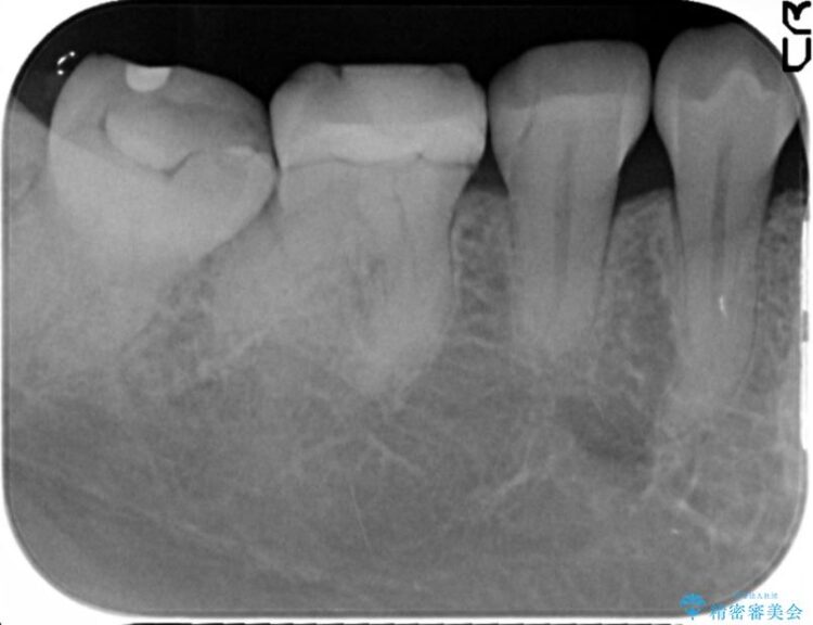 【40代女性】古い不適合な詰め物をセラミックインレーで再治療 治療後画像