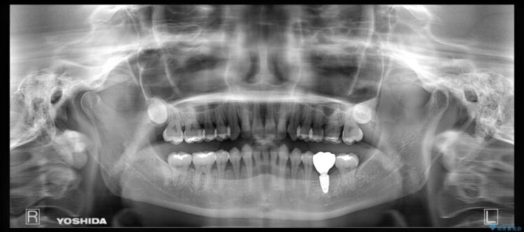 【30代女性】歯根破折と歯列矯正の治療で噛み合わせを改善 治療後画像