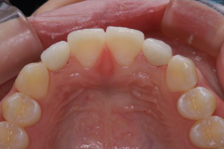 【10代女性】生まれつき小さい歯をセラミックで補綴しすきっ歯を改善する 治療後画像