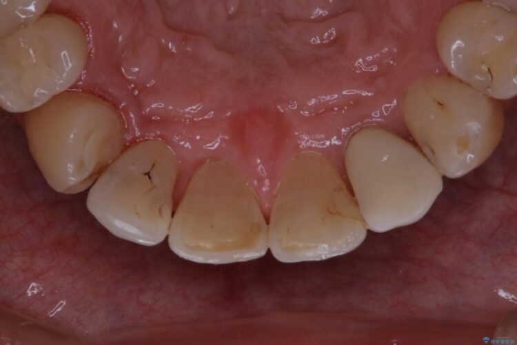 【40代男性】インビザライン治療中の頑固な着色落としをクリーニング 治療後画像