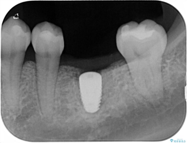 【30代女性】歯根破折と歯列矯正の治療で噛み合わせを改善 治療後画像