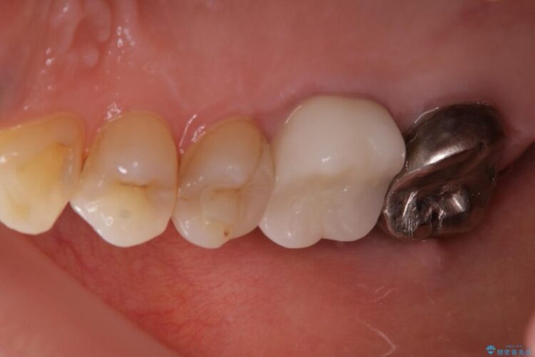 【40代女性】繰り返しニキビのようなものができる 治療後画像