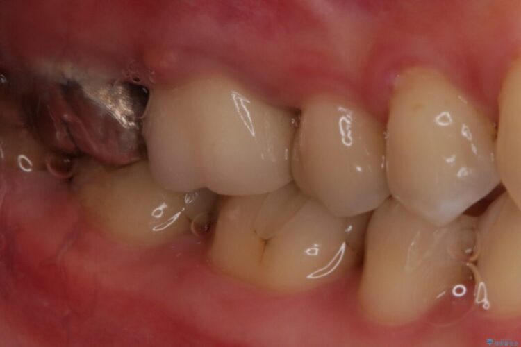 【40代女性】繰り返しニキビのようなものができる 治療前画像