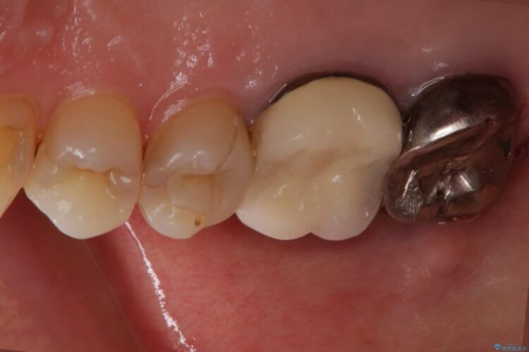 【40代女性】繰り返しニキビのようなものができる 治療前画像