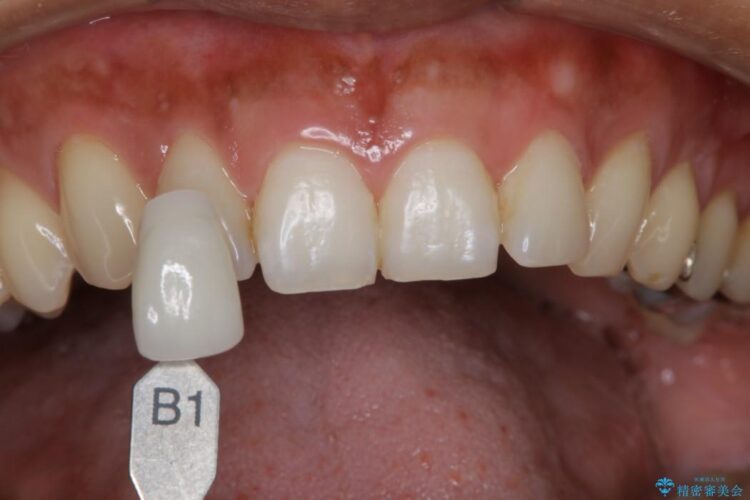 【20代男性】エクセレントホワイトニング 治療前画像