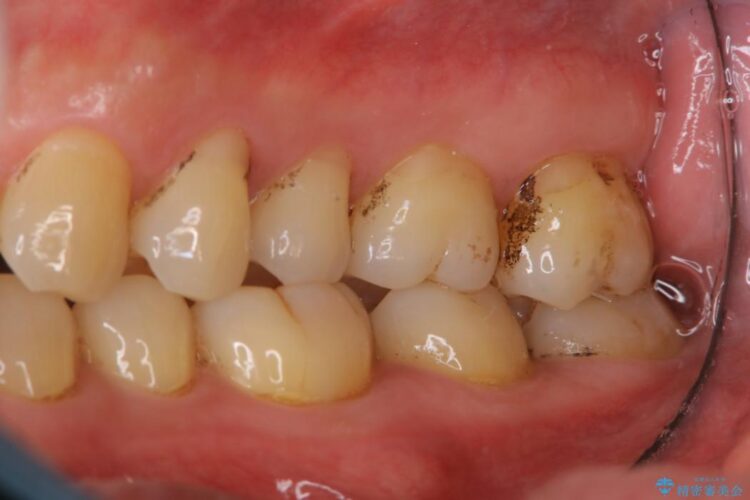 【40代男性】歯にこびりついた着色のクリーニング 治療前画像