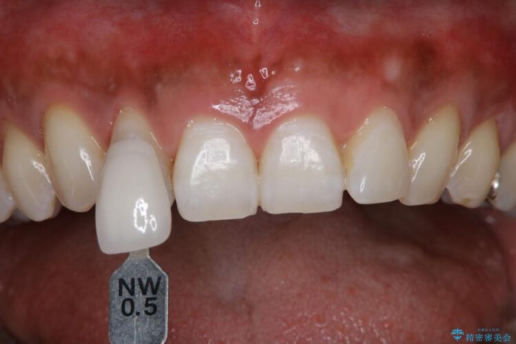 【20代男性】エクセレントホワイトニング 治療後画像