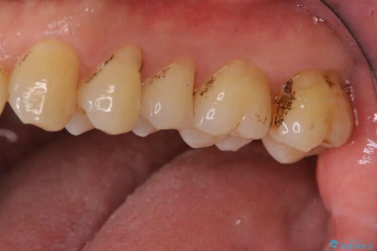 【40代男性】歯にこびりついた着色のクリーニング 治療前画像