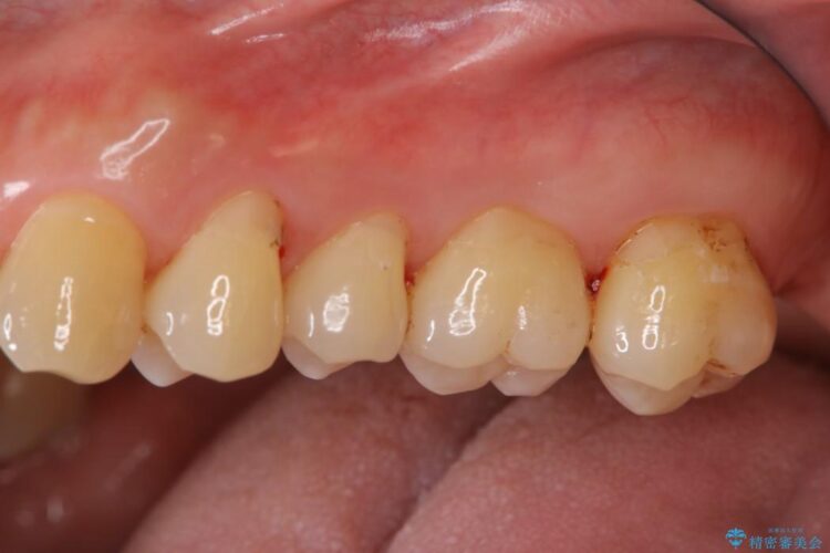【40代男性】歯にこびりついた着色のクリーニング 治療後画像