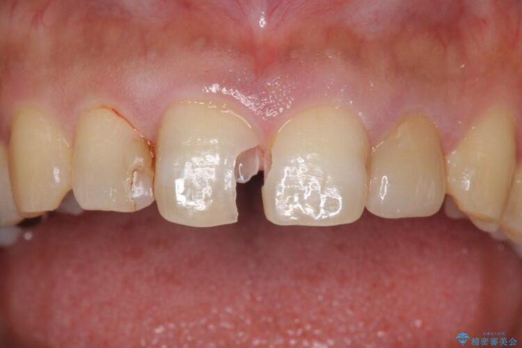 【30代男性】神経一歩手前の深い虫歯をセラミッククラウンで治療 治療途中画像