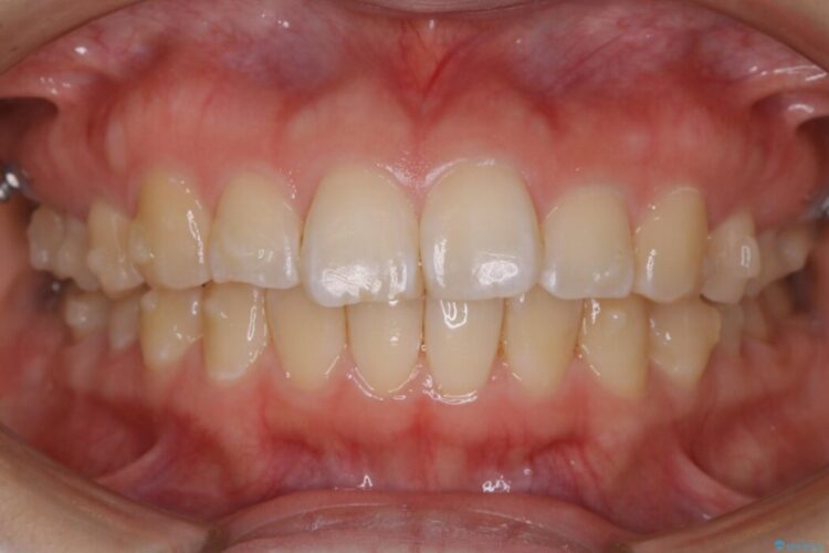 【30代女性】歯を長持ちさせるための咬合調整 治療途中画像