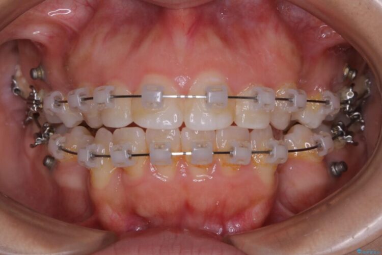 【20代女性】口元を引っ込めたい Eラインの改善 治療途中画像