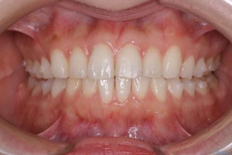 【20代女性】短期間でのインビザライン治療で見た目の悩みを改善する 治療途中画像