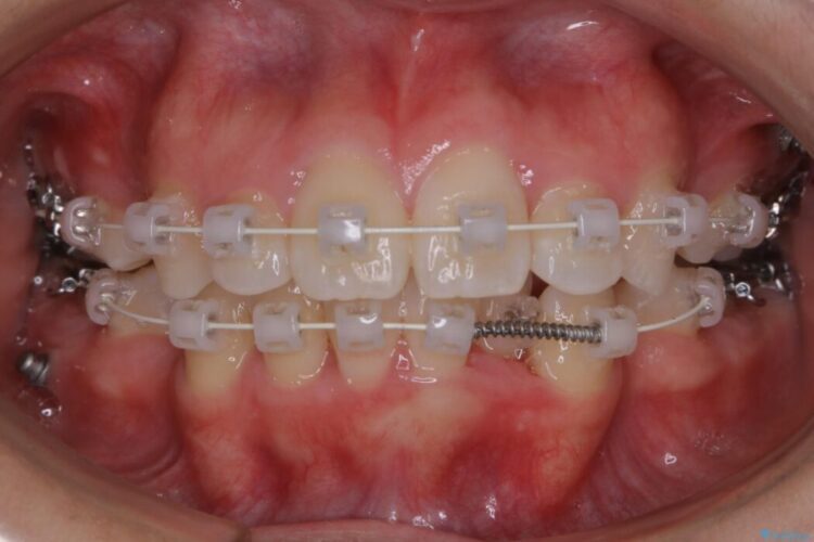 【20代女性】抜歯矯正で出っ張った口元を改善する 治療途中画像