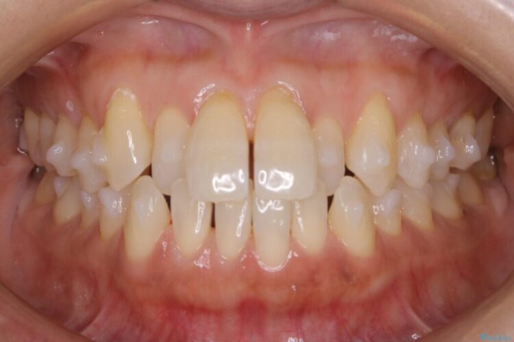 【30代女性】短期間で非抜歯による反対咬合(受け口)の改善 治療途中画像