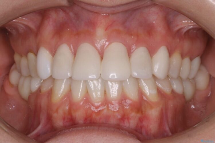 【30代女性】前歯の見た目をセラミッククラウンで変える 治療途中画像