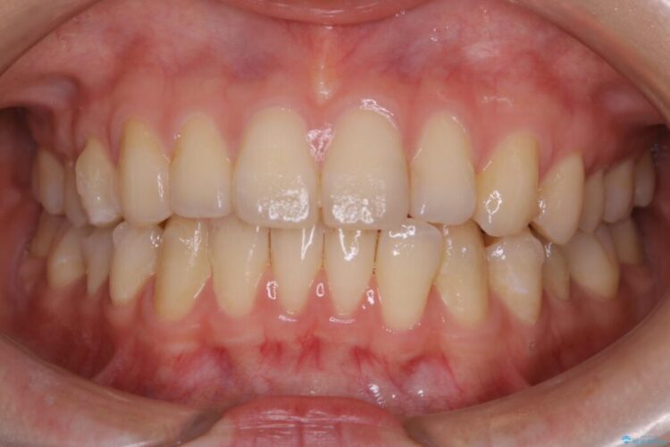 【20代女性】気になる部分だけをマウスピース矯正 治療途中画像