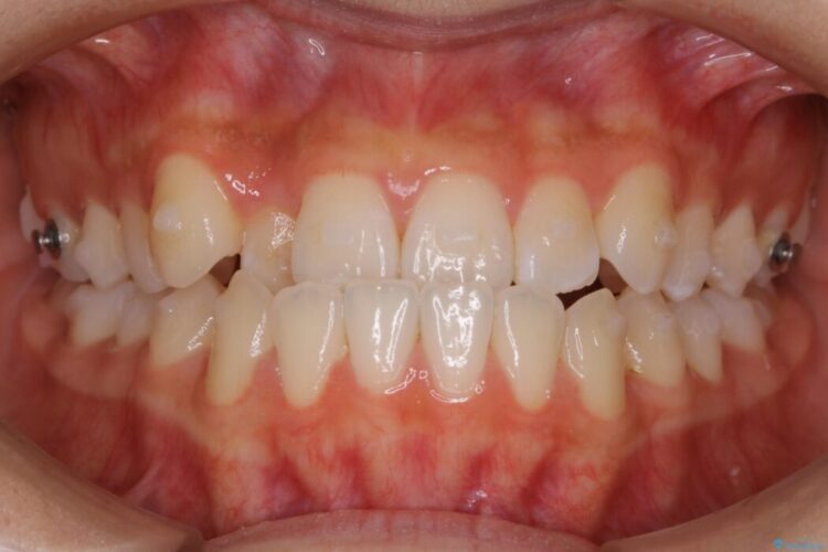 【10代女性】早めに始める受け口（反対咬合）の矯正治療 治療途中画像