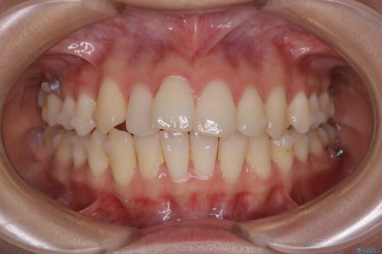 【20代女性】非抜歯でもガタガタを改善するインビザライン矯正 治療途中画像