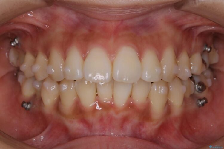 【20代女性】非抜歯でマウスピースの限界に挑戦する矯正治療 治療途中画像