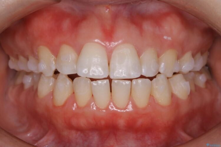 【20代女性】前歯が噛み合わない!開咬（オープンバイト）の矯正治療 治療途中画像