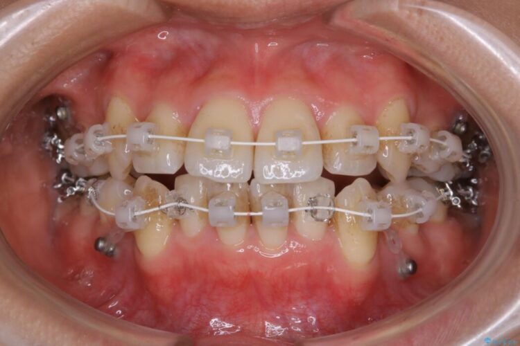 【20代女性】抜歯ワイヤー矯正で八重歯がスッキリ 治療途中画像